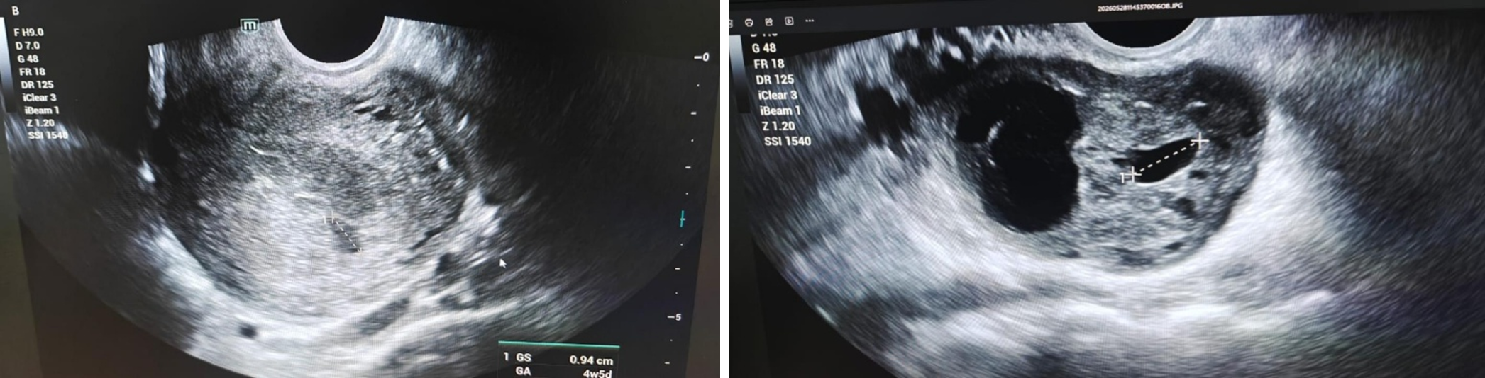 USG findings showing 0.94 cm sized Gsac in uterine cavity (left) and right ovarian Gsac (right)